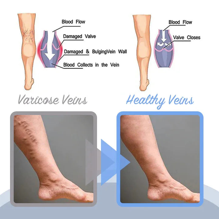 Treatment For Varicose Vein | Varicose Veins Spray | Deep Cleansing