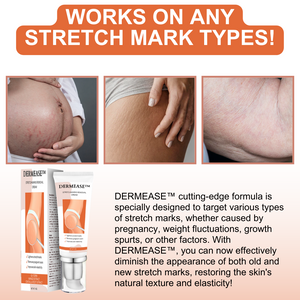 CC™ Stretchmarks Removal Cream