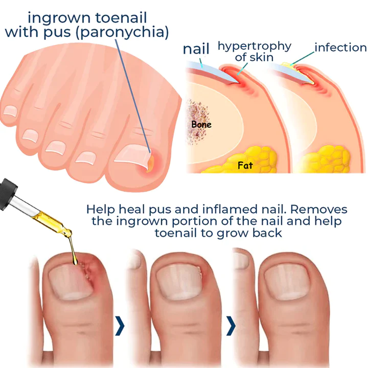 German ToenailCare™ Removal Paronychia Oil