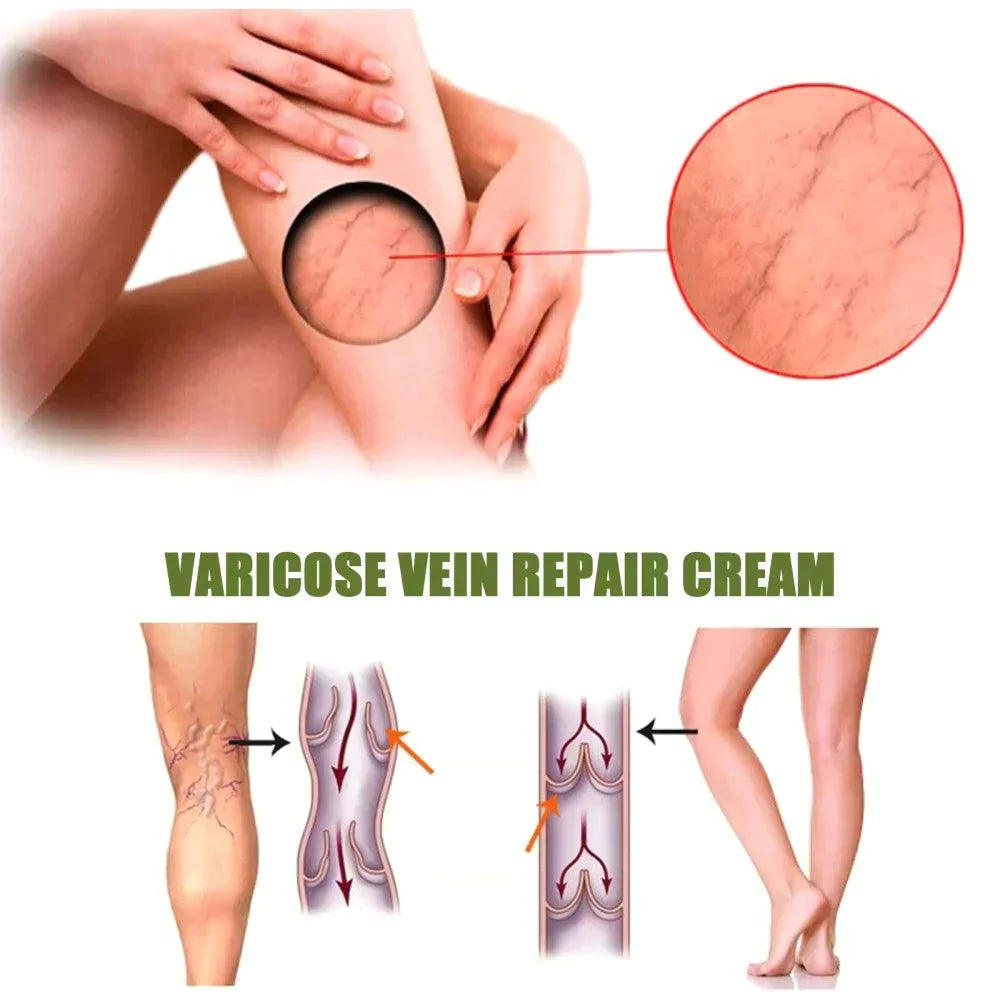 Oveallgo™ Varicose Veins Spray