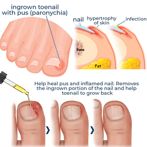 German ToenailCare™ Removal Paronychia Oil