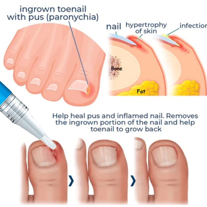 CC™ Removal Paronychia Gel