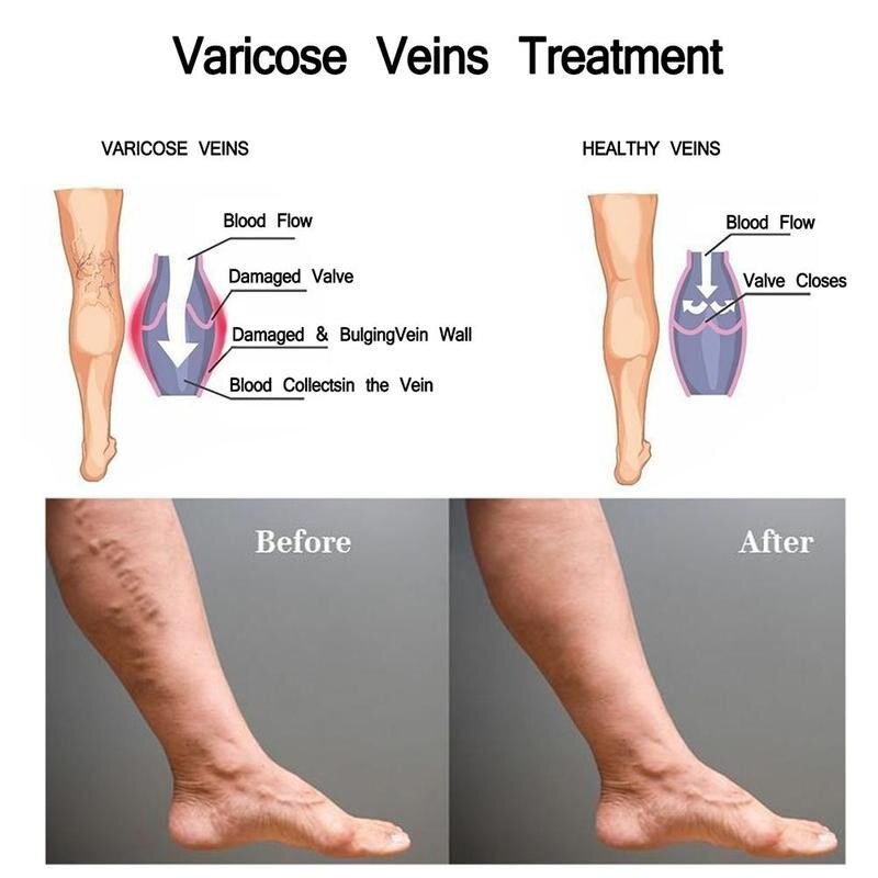 Varicose Veins Cream | Varicose Veins Treatment Spray | Deep Cleansing