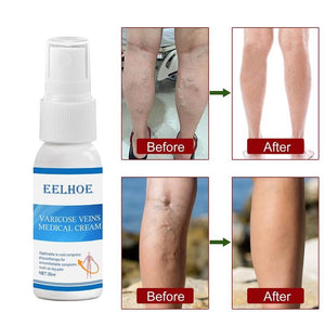 Varicose Veins Cream | Varicose Veins Treatment Spray | Deep Cleansing