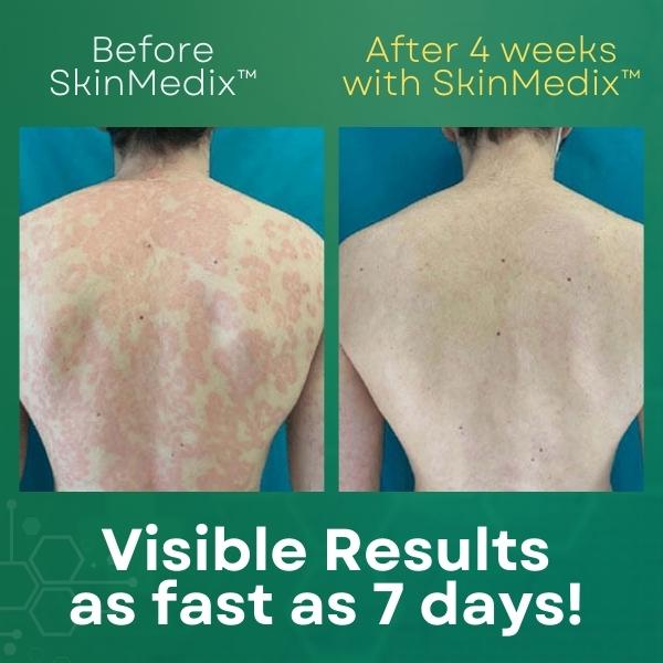 Psoriasis Treatment Cream | SkinMedix Psoriasis Cream | Deep Cleansing