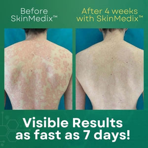 Psoriasis Treatment Cream | SkinMedix Psoriasis Cream | Deep Cleansing