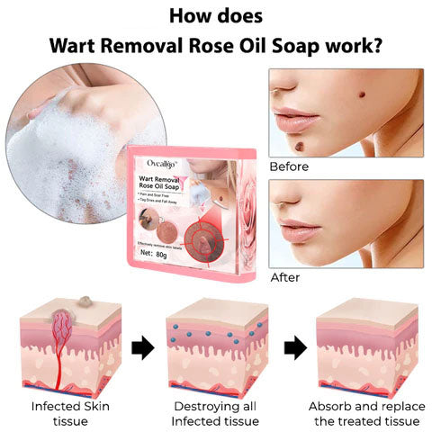 CC™ Wart Removal Rose Oil Soap