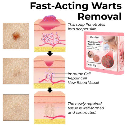 CC™ Wart Removal Rose Oil Soap