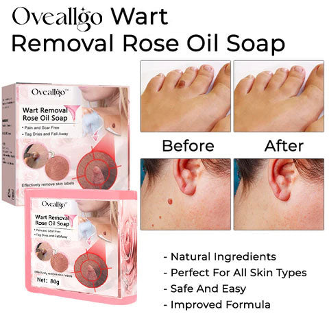 CC™ Wart Removal Rose Oil Soap