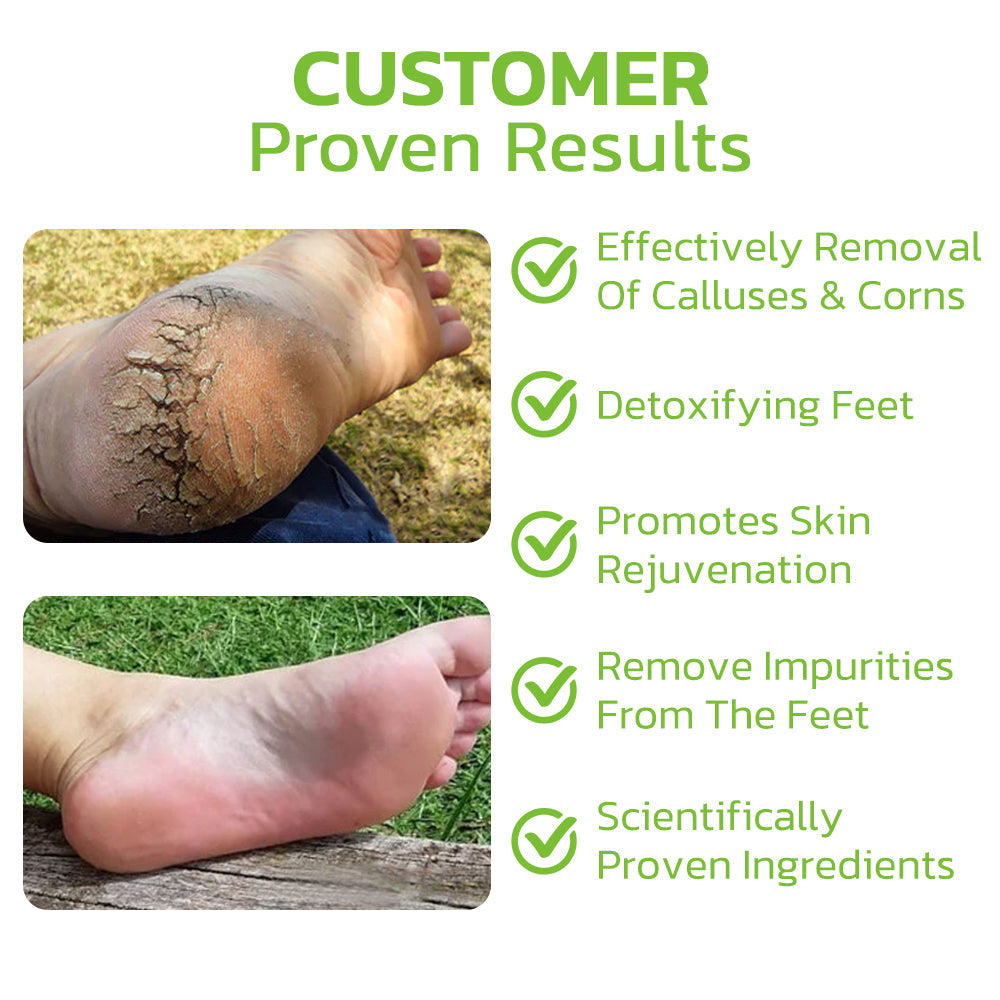 CC™ IHerbal Foot Callus And Corns Removal Soak