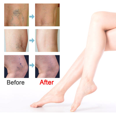 BeauSkin Spider Veins Repair Cream