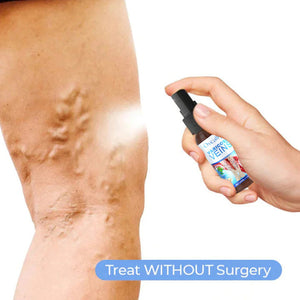 Treatment For Varicose Vein | Varicose Veins Spray | Deep Cleansing