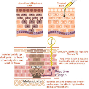 Acanthosis Nigricans Treatment Oil | Get Rid Dark Neck| Deep Cleansing