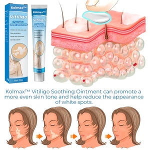 Vitiligo Treatment Cream | Vitiligo Soothing Ointment | Deep Cleansing